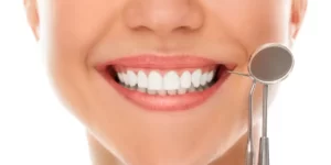smile makeover veneers