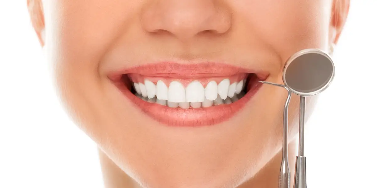 smile makeover veneers